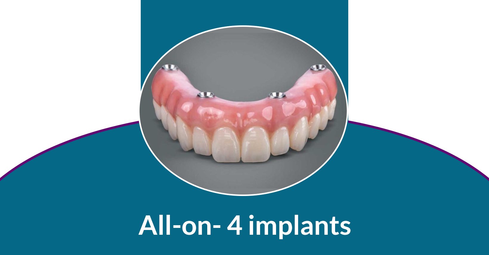 All on 4 Dental Implants Near Me Glendale Family Dentist