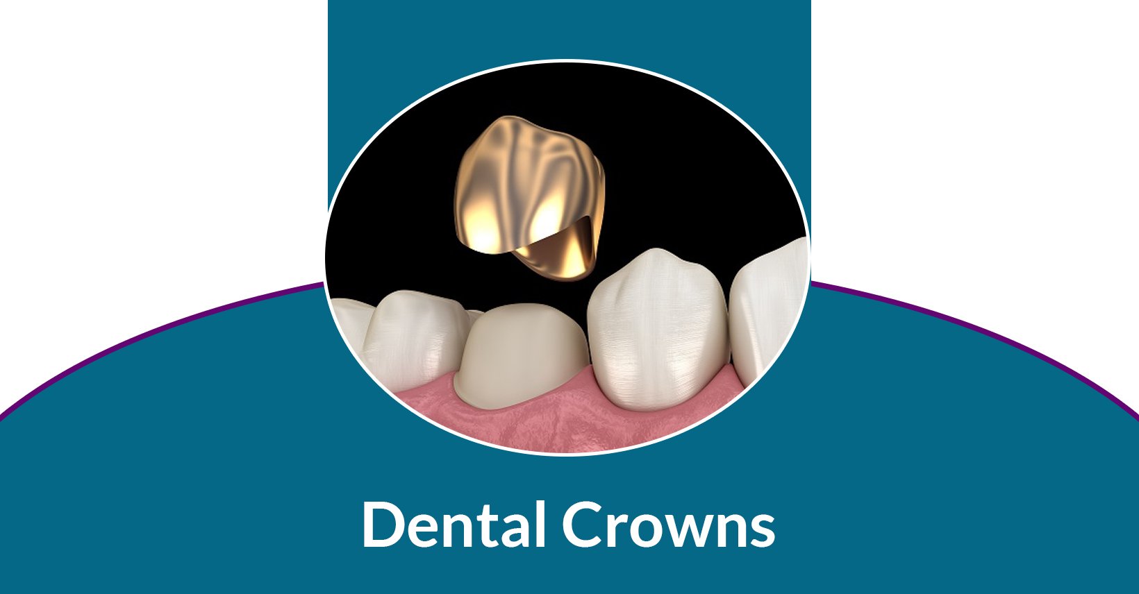 Dental Crowns Glendale AZ CEREC Same Day Crowns