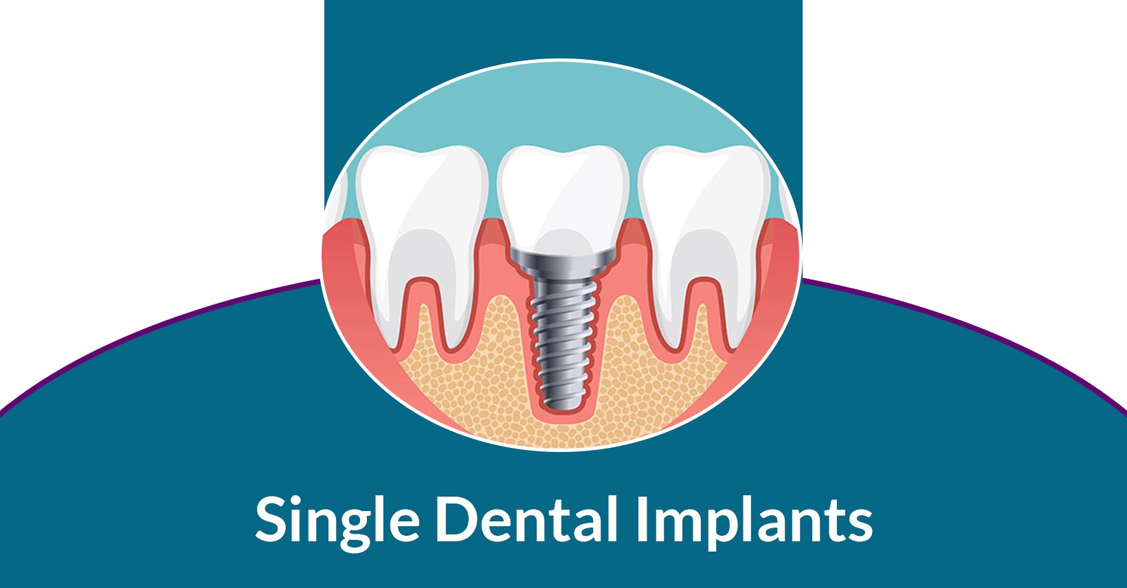 Single Tooth Dental Implants Glendale, AZ