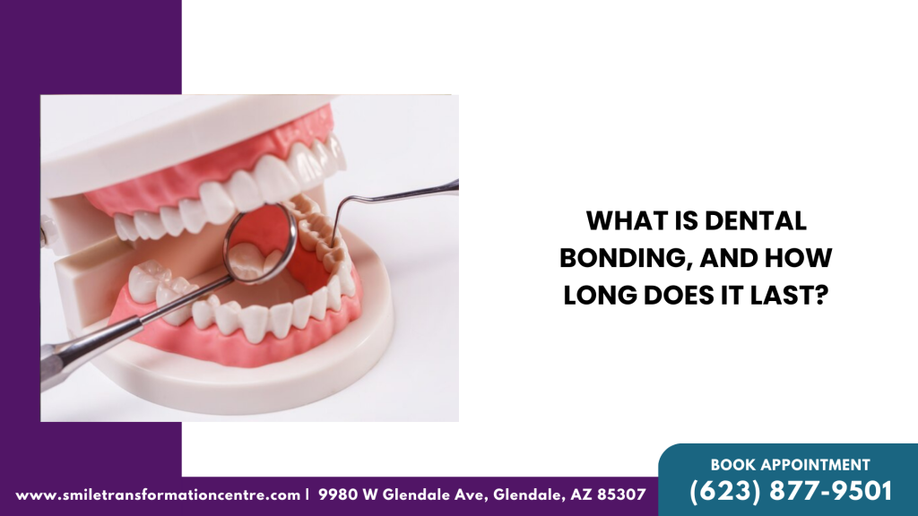 What is Dental Bonding, And How Long Does It Last