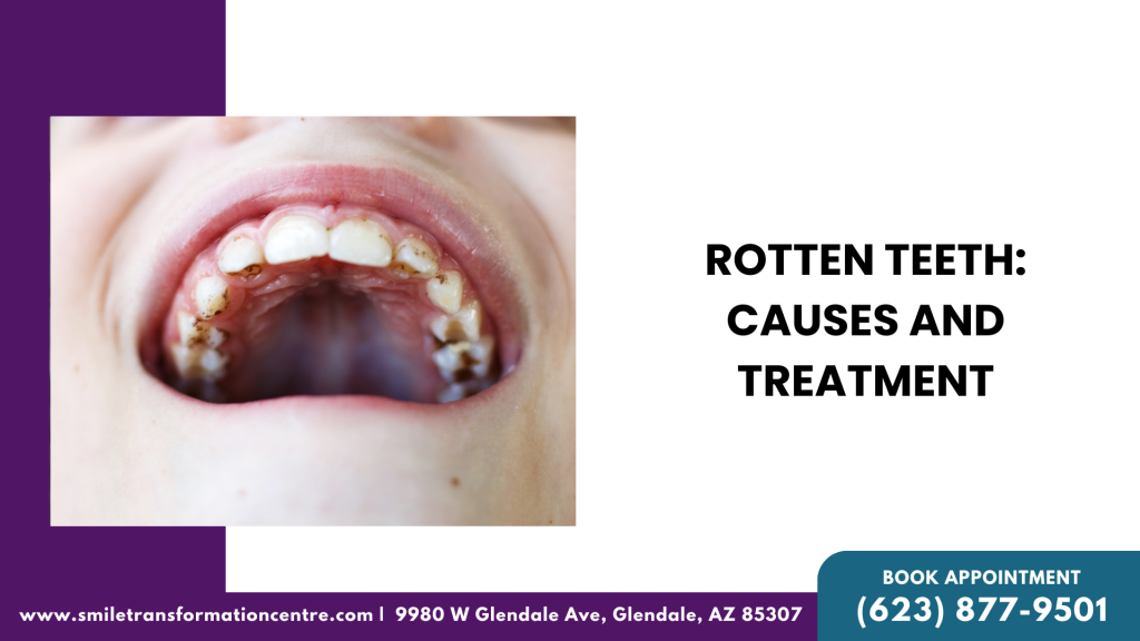 Rotten Teeth Causes and Treatment