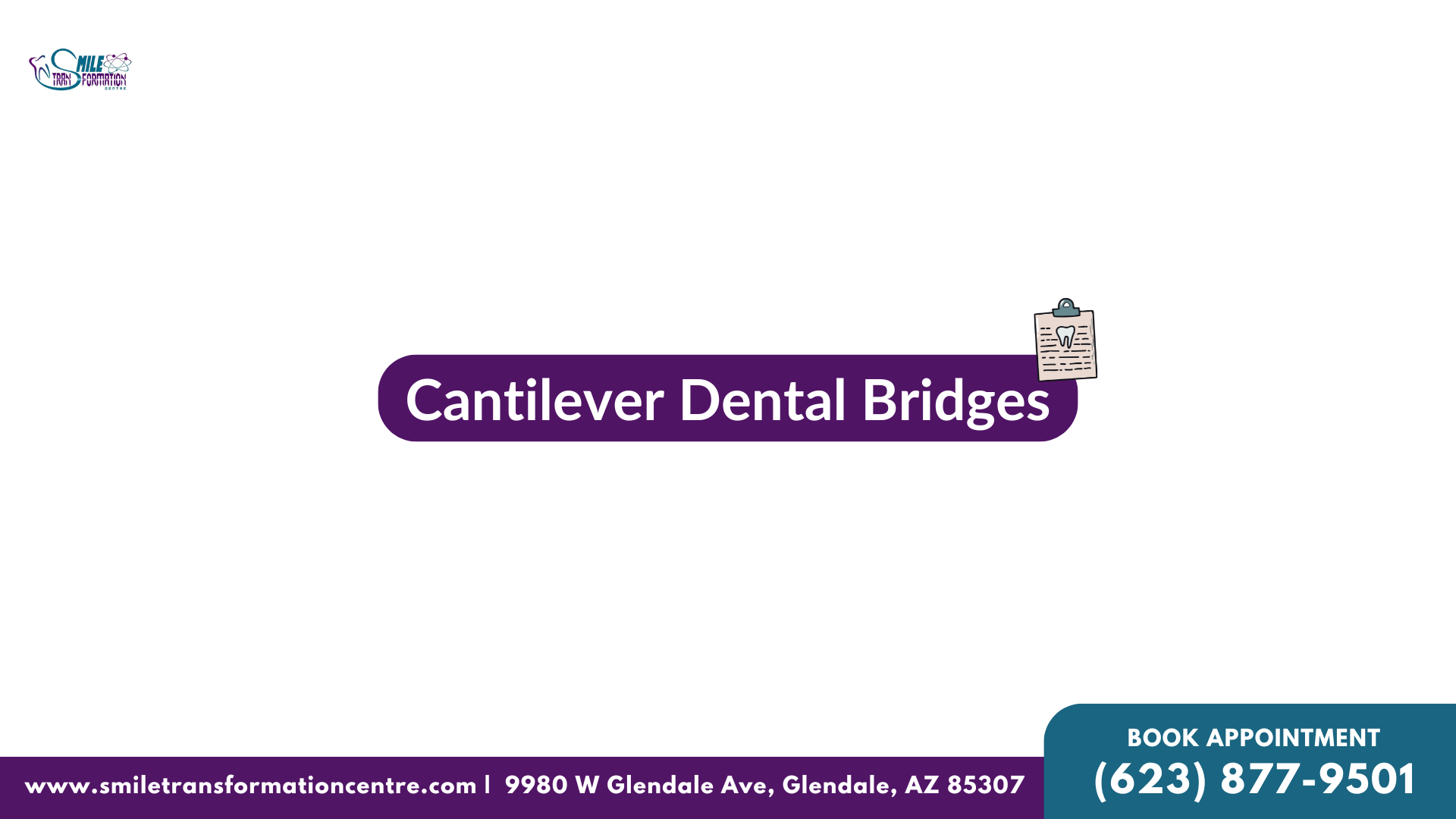 Cantilever Dental Bridges